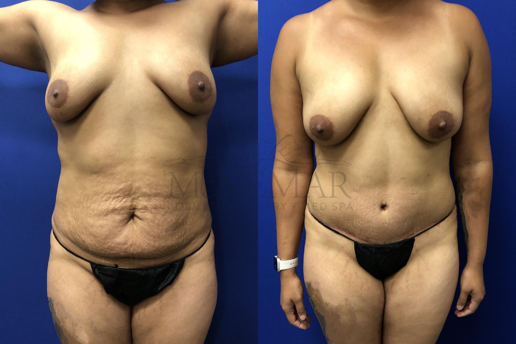 Tummy Tuck (Abdominoplasty) Case 142 Before & After Front | San Ramon & Tracy, CA | McNemar Cosmetic Surgery