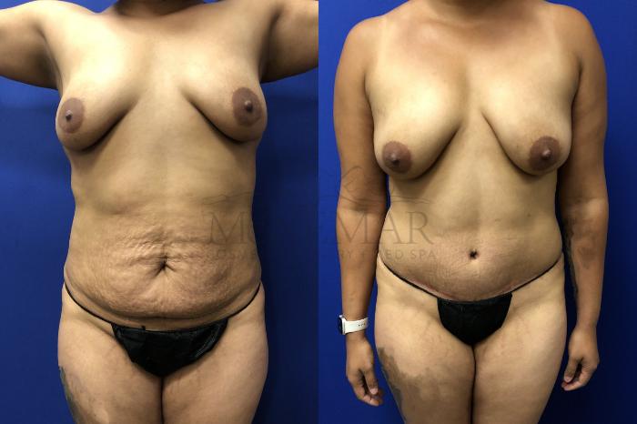 Tummy Tuck (Abdominoplasty) Case 142 Before & After Front | Tracy, Brentwood & Livermore, CA | McNemar Cosmetic Surgery