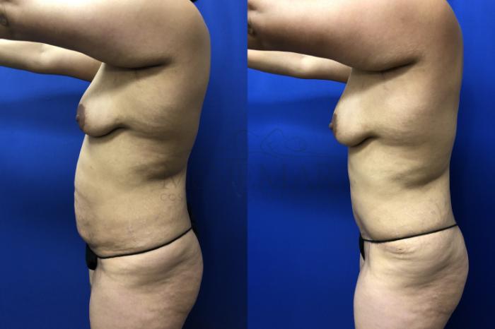 Tummy Tuck (Abdominoplasty) Case 142 Before & After Right Side | San Ramon & Tracy, CA | McNemar Cosmetic Surgery
