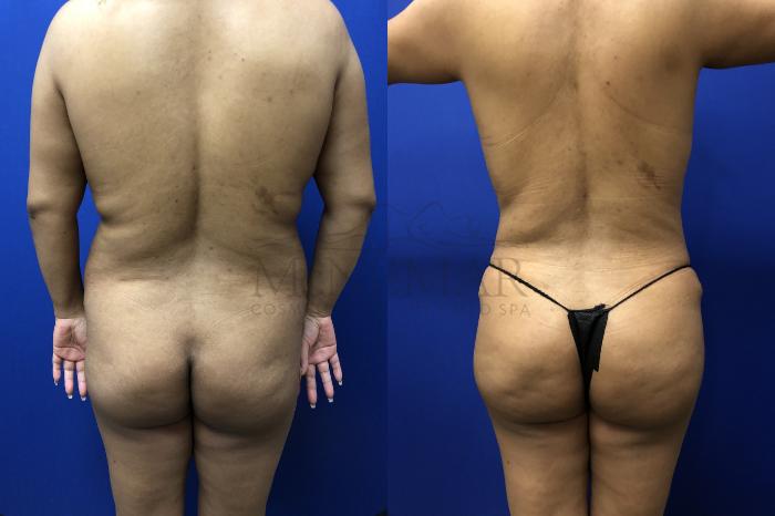 Brazilian Butt Lift (BBL) Case 143 Before & After Back | Tracy, Brentwood & Livermore, CA | McNemar Cosmetic Surgery