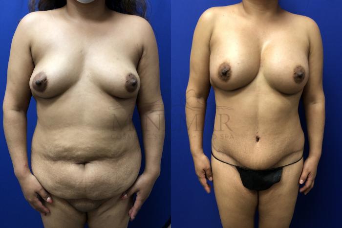 Brazilian Butt Lift (BBL) Case 143 Before & After Front | San Ramon & Tracy, CA | McNemar Cosmetic Surgery