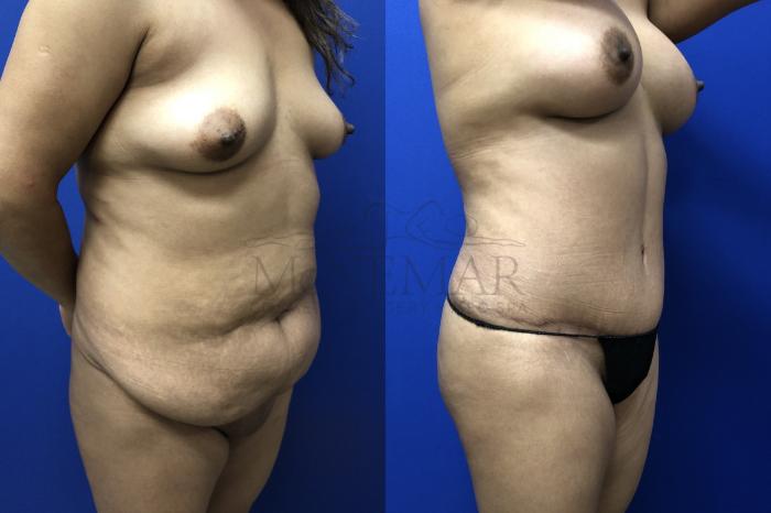 Breast Augmentation Case 143 Before & After Left Oblique | Tracy, Brentwood & Livermore, CA | McNemar Cosmetic Surgery