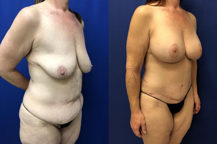 Tummy Tuck (Abdominoplasty) Case 157 Before & After Left Oblique | Tracy, Brentwood & Livermore, CA | McNemar Cosmetic Surgery