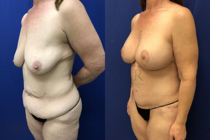 Tummy Tuck (Abdominoplasty) Case 157 Before & After Right Oblique | Tracy, Brentwood & Livermore, CA | McNemar Cosmetic Surgery