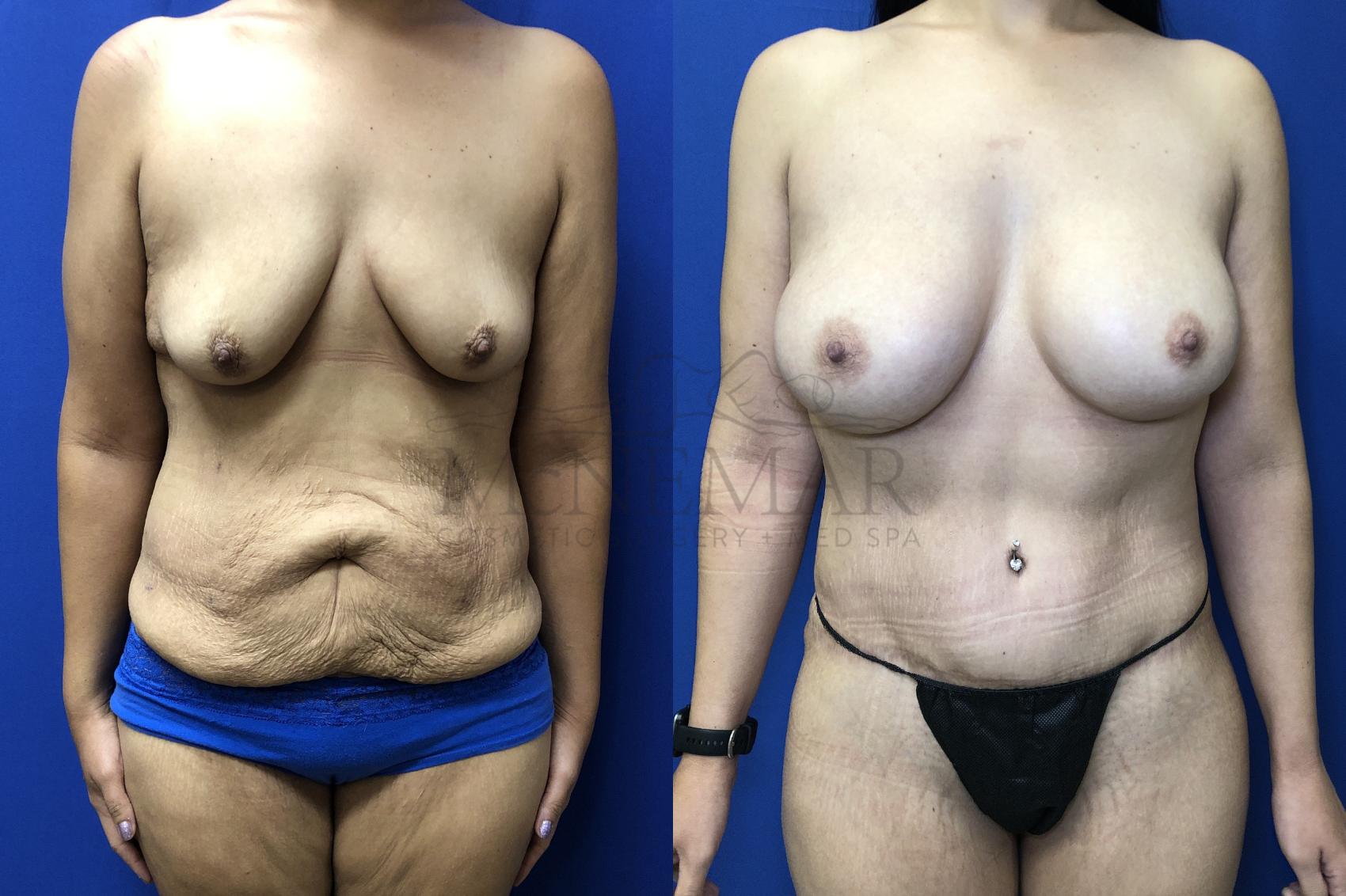 Tummy Tuck (Abdominoplasty) Case 187 Before & After Front | Tracy, Brentwood & Livermore, CA | McNemar Cosmetic Surgery