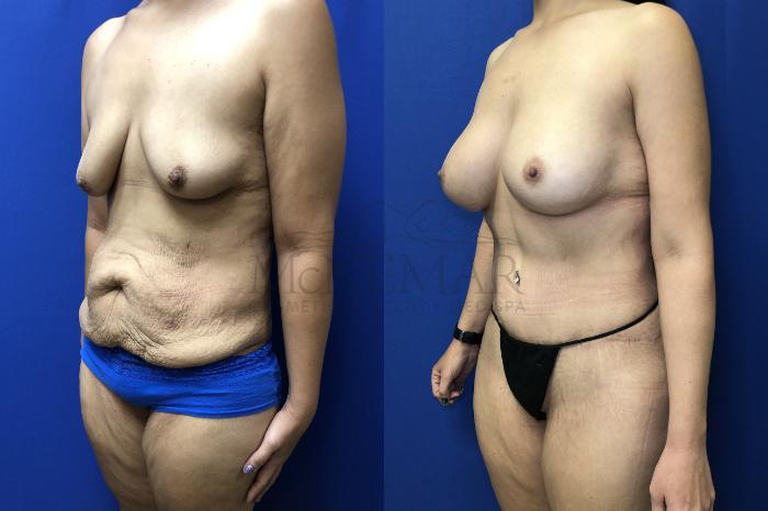 Tummy Tuck (Abdominoplasty) Case 187 Before & After Left Side | Tracy, Brentwood & Livermore, CA | McNemar Cosmetic Surgery