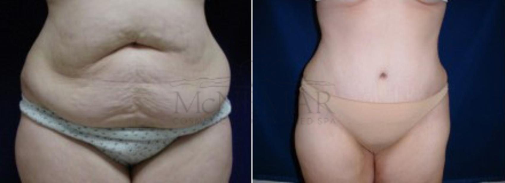 Tummy Tuck (Abdominoplasty) Case 19 Before & After View #1 | San Ramon & Tracy, CA | McNemar Cosmetic Surgery