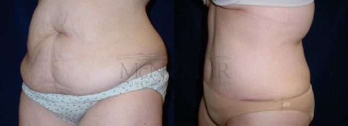 Tummy Tuck (Abdominoplasty) Case 19 Before & After View #2 | San Ramon & Tracy, CA | McNemar Cosmetic Surgery