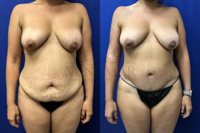 Tummy Tuck (Abdominoplasty) Case 198 Before & After Front | Tracy, Brentwood & Livermore, CA | McNemar Cosmetic Surgery