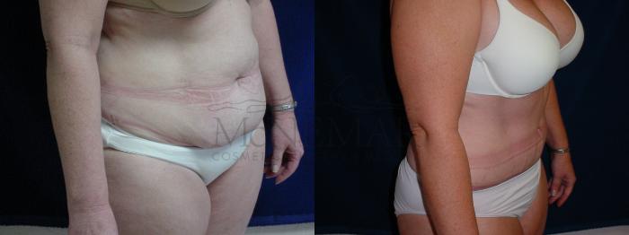 Tummy Tuck (Abdominoplasty) Case 30 Before & After View #1 | Tracy, Brentwood & Livermore, CA | McNemar Cosmetic Surgery