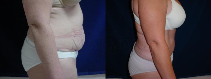 Tummy Tuck (Abdominoplasty) Case 30 Before & After View #2 | Tracy, Brentwood & Livermore, CA | McNemar Cosmetic Surgery