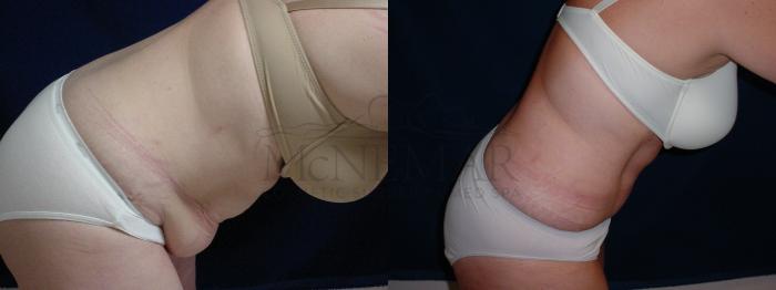 Tummy Tuck (Abdominoplasty) Case 30 Before & After View #3 | Tracy, Brentwood & Livermore, CA | McNemar Cosmetic Surgery