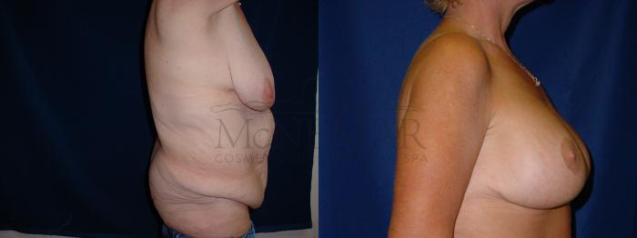 Tummy Tuck (Abdominoplasty) Case 33 Before & After View #3 | San Ramon & Tracy, CA | McNemar Cosmetic Surgery
