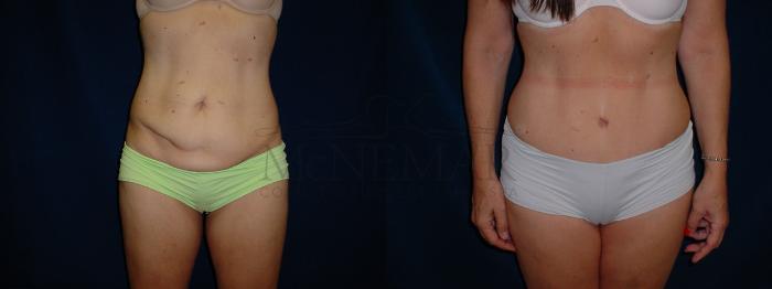 Tummy Tuck (Abdominoplasty) Case 35 Before & After View #1 | Tracy, Brentwood & Livermore, CA | McNemar Cosmetic Surgery