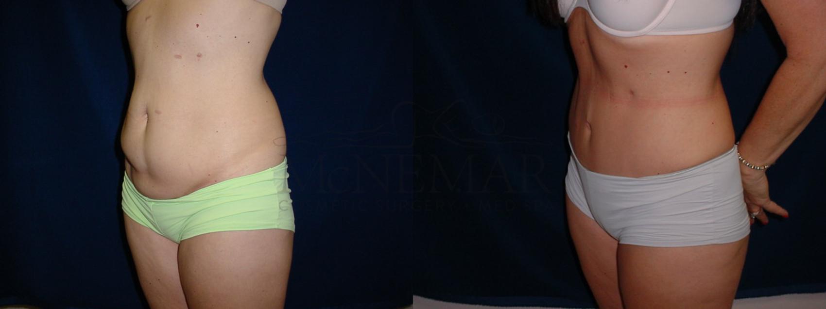 Tummy Tuck (Abdominoplasty) Case 35 Before & After View #2 | San Ramon & Tracy, CA | McNemar Cosmetic Surgery