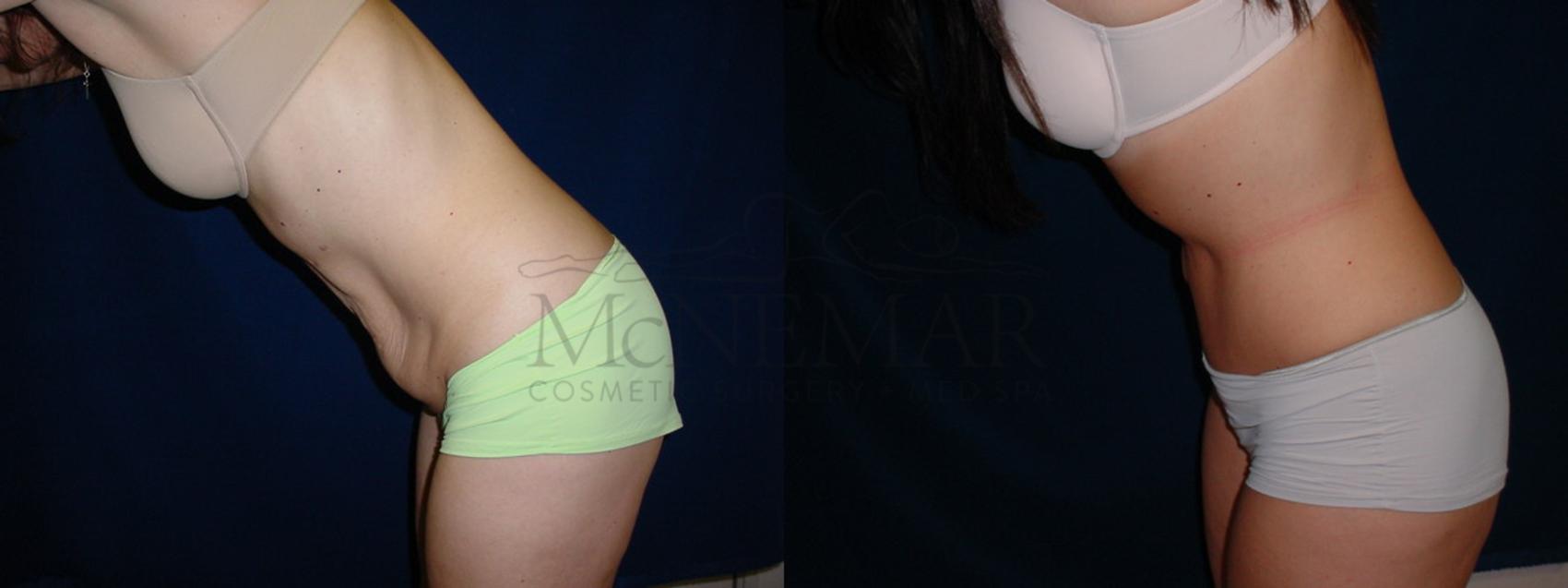 Tummy Tuck (Abdominoplasty) Case 35 Before & After View #3 | San Ramon & Tracy, CA | McNemar Cosmetic Surgery