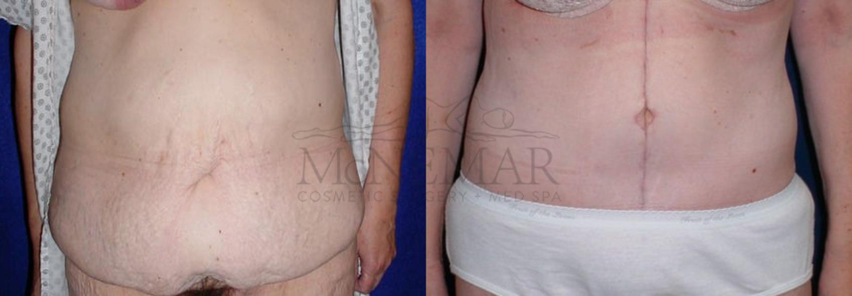 Tummy Tuck (Abdominoplasty) Case 48 Before & After View #1 | San Ramon & Tracy, CA | McNemar Cosmetic Surgery