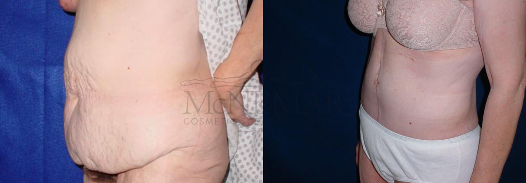 Tummy Tuck (Abdominoplasty) Case 48 Before & After View #2 | San Ramon & Tracy, CA | McNemar Cosmetic Surgery