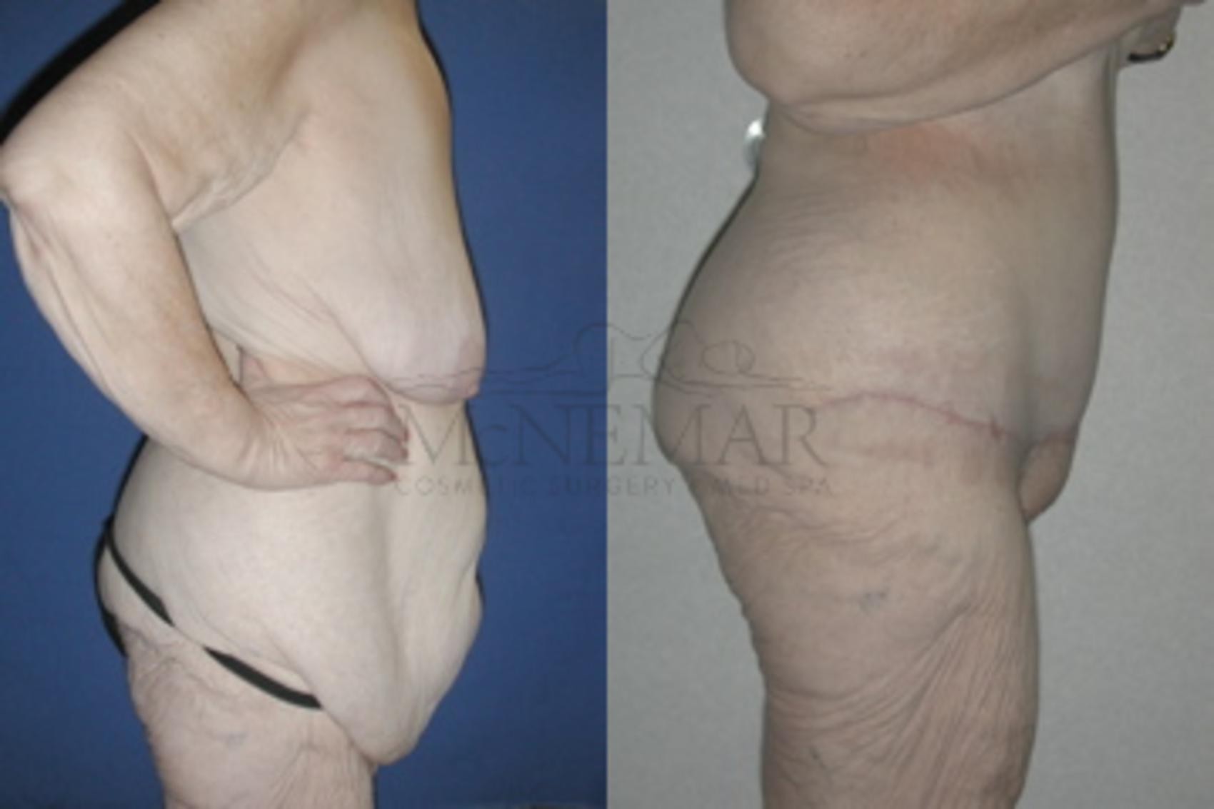 Tummy Tuck (Abdominoplasty) Case 49 Before & After View #4 | San Ramon & Tracy, CA | McNemar Cosmetic Surgery