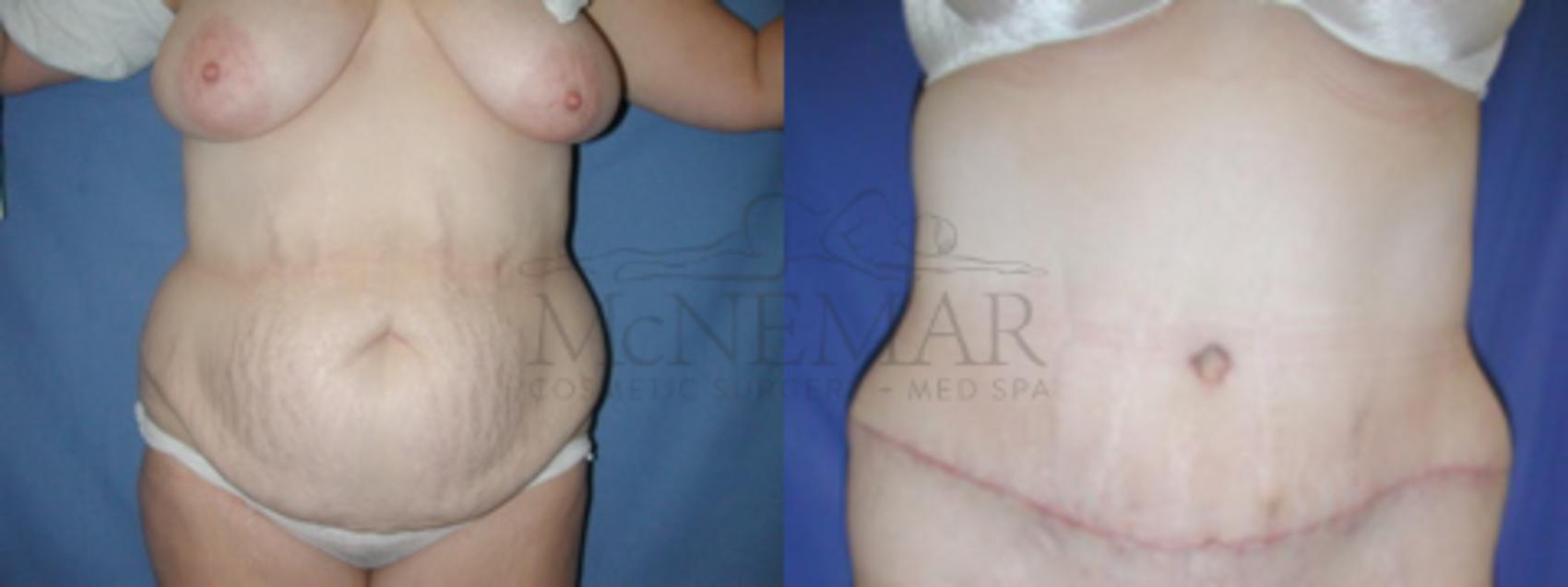 Tummy Tuck (Abdominoplasty) Case 51 Before & After View #2 | Tracy, Brentwood & Livermore, CA | McNemar Cosmetic Surgery