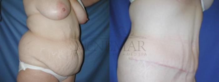 Tummy Tuck (Abdominoplasty) Case 51 Before & After View #3 | San Ramon & Tracy, CA | McNemar Cosmetic Surgery