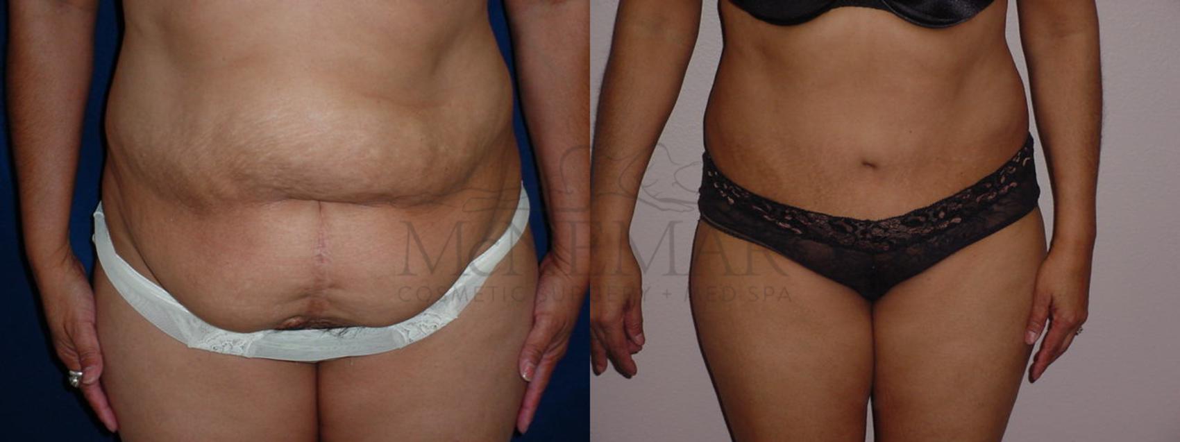 Tummy Tuck (Abdominoplasty) Case 64 Before & After View #1 | San Ramon & Tracy, CA | McNemar Cosmetic Surgery