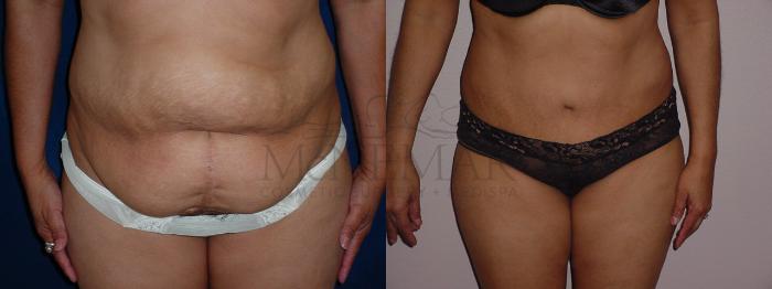 Tummy Tuck (Abdominoplasty) Case 64 Before & After View #1 | Tracy, Brentwood & Livermore, CA | McNemar Cosmetic Surgery