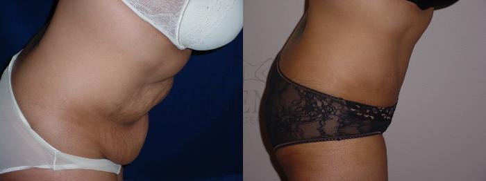 Tummy Tuck (Abdominoplasty) Case 64 Before & After View #2 | Tracy, Brentwood & Livermore, CA | McNemar Cosmetic Surgery