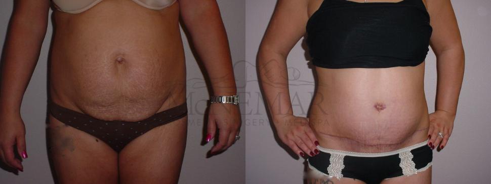 Tummy Tuck (Abdominoplasty) Case 65 Before & After View #1 | San Ramon & Tracy, CA | McNemar Cosmetic Surgery