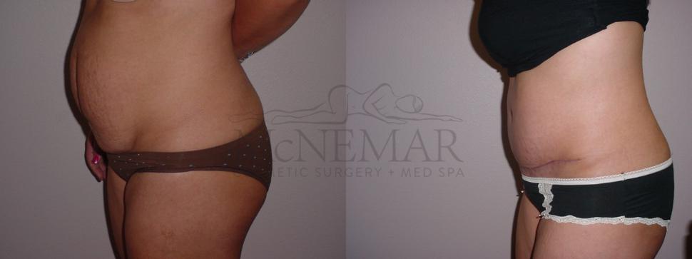 Tummy Tuck (Abdominoplasty) Case 65 Before & After View #2 | San Ramon & Tracy, CA | McNemar Cosmetic Surgery
