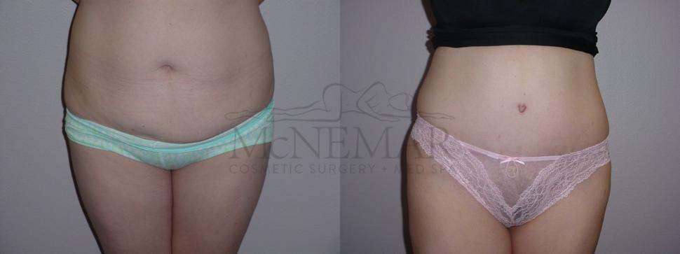 Tummy Tuck (Abdominoplasty) Case 66 Before & After View #1 | San Ramon & Tracy, CA | McNemar Cosmetic Surgery
