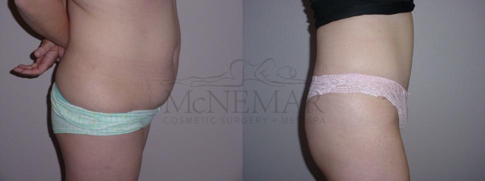 Tummy Tuck (Abdominoplasty) Case 66 Before & After View #2 | San Ramon & Tracy, CA | McNemar Cosmetic Surgery