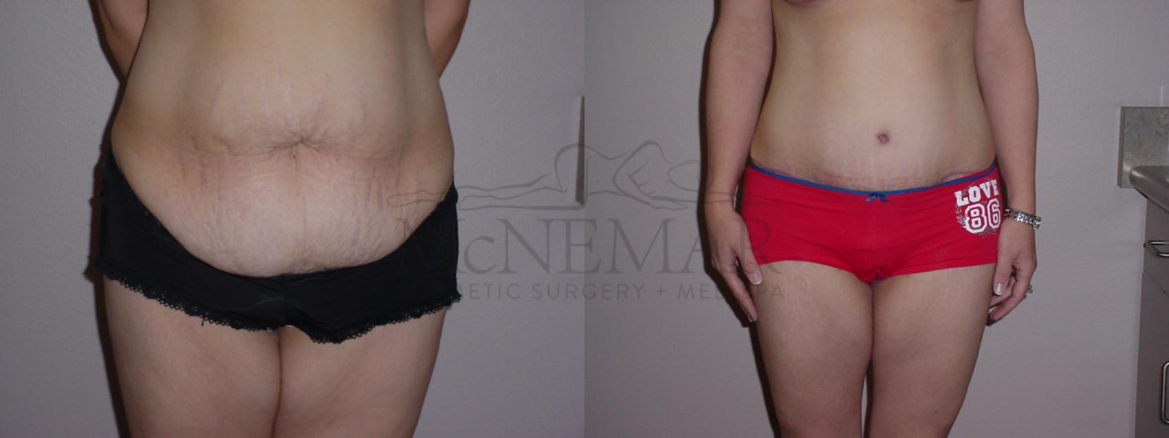 Tummy Tuck (Abdominoplasty) Case 71 Before & After View #1 | San Ramon & Tracy, CA | McNemar Cosmetic Surgery