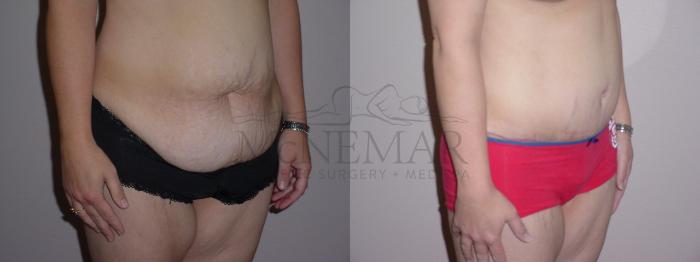 Tummy Tuck (Abdominoplasty) Case 71 Before & After View #2 | Tracy, Brentwood & Livermore, CA | McNemar Cosmetic Surgery