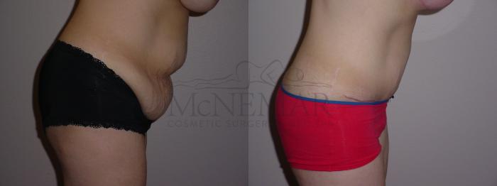 Tummy Tuck (Abdominoplasty) Case 71 Before & After View #3 | Tracy, Brentwood & Livermore, CA | McNemar Cosmetic Surgery