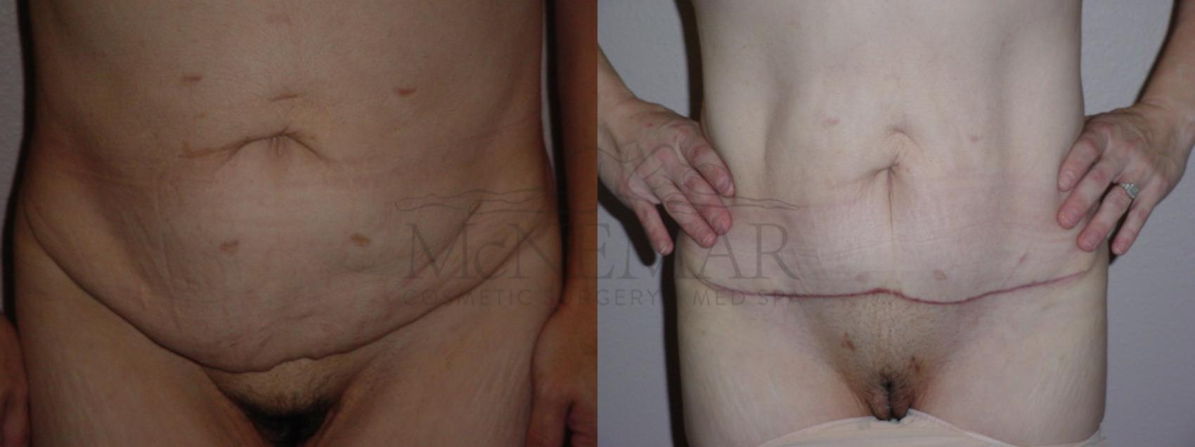 Tummy Tuck (Abdominoplasty) Case 73 Before & After View #1 | Tracy, Brentwood & Livermore, CA | McNemar Cosmetic Surgery