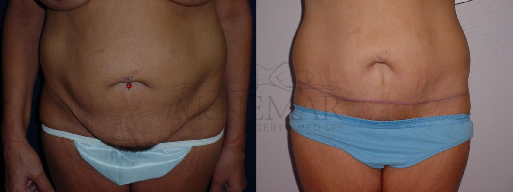 Tummy Tuck (Abdominoplasty) Case 77 Before & After View #1 | Tracy, Brentwood & Livermore, CA | McNemar Cosmetic Surgery