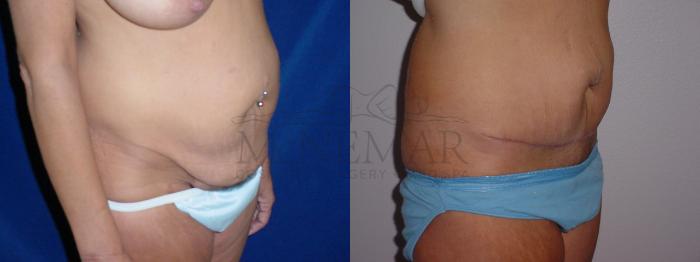 Tummy Tuck (Abdominoplasty) Case 77 Before & After View #2 | San Ramon & Tracy, CA | McNemar Cosmetic Surgery