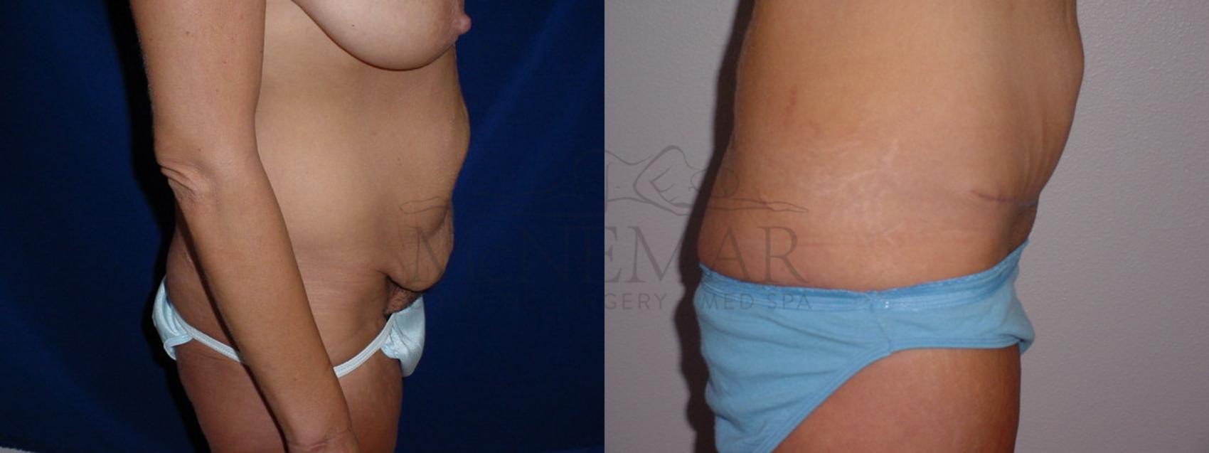 Tummy Tuck (Abdominoplasty) Case 77 Before & After View #3 | San Ramon & Tracy, CA | McNemar Cosmetic Surgery