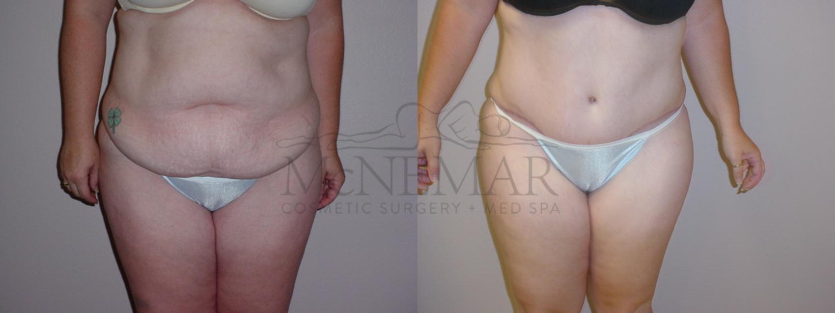 Tummy Tuck (Abdominoplasty) Case 83 Before & After View #1 | San Ramon & Tracy, CA | McNemar Cosmetic Surgery