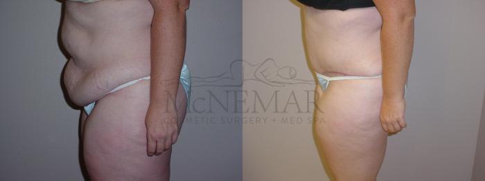 Tummy Tuck (Abdominoplasty) Case 83 Before & After View #2 | Tracy, Brentwood & Livermore, CA | McNemar Cosmetic Surgery