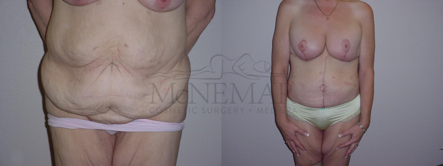 Tummy Tuck (Abdominoplasty) Case 90 Before & After View #1 | Tracy, Brentwood & Livermore, CA | McNemar Cosmetic Surgery