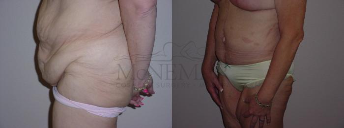 Tummy Tuck (Abdominoplasty) Case 90 Before & After View #2 | Tracy, Brentwood & Livermore, CA | McNemar Cosmetic Surgery