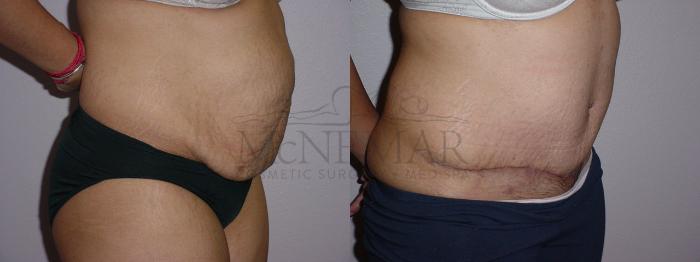 Tummy Tuck (Abdominoplasty) Case 93 Before & After View #2 | San Ramon & Tracy, CA | McNemar Cosmetic Surgery