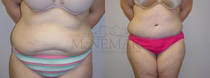 Tummy Tuck (Abdominoplasty) Case 96 Before & After View #1 | San Ramon & Tracy, CA | McNemar Cosmetic Surgery