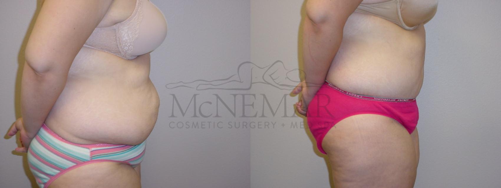 Tummy Tuck (Abdominoplasty) Case 96 Before & After View #2 | San Ramon & Tracy, CA | McNemar Cosmetic Surgery