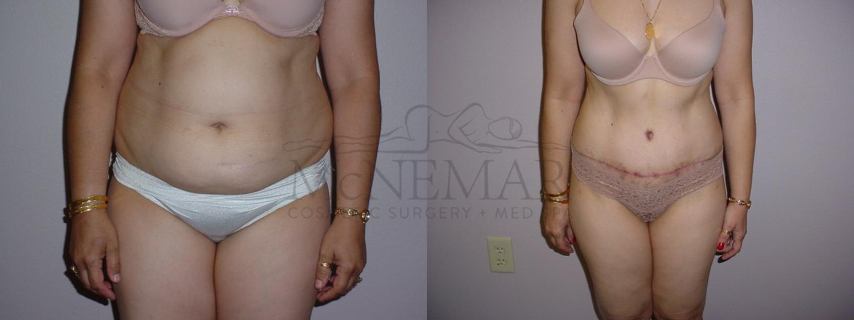 Tummy Tuck (Abdominoplasty) Case 97 Before & After View #1 | San Ramon & Tracy, CA | McNemar Cosmetic Surgery