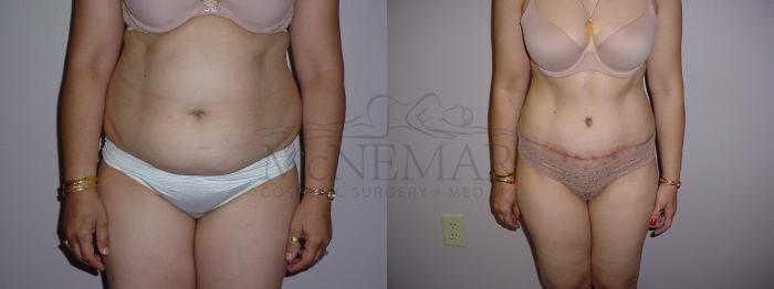 Tummy Tuck (Abdominoplasty) Case 97 Before & After View #1 | San Ramon & Tracy, CA | McNemar Cosmetic Surgery